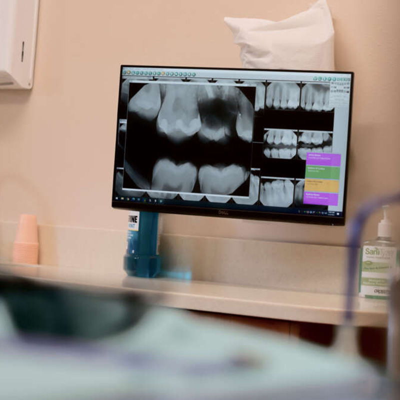 X-Ray of damaged teeth